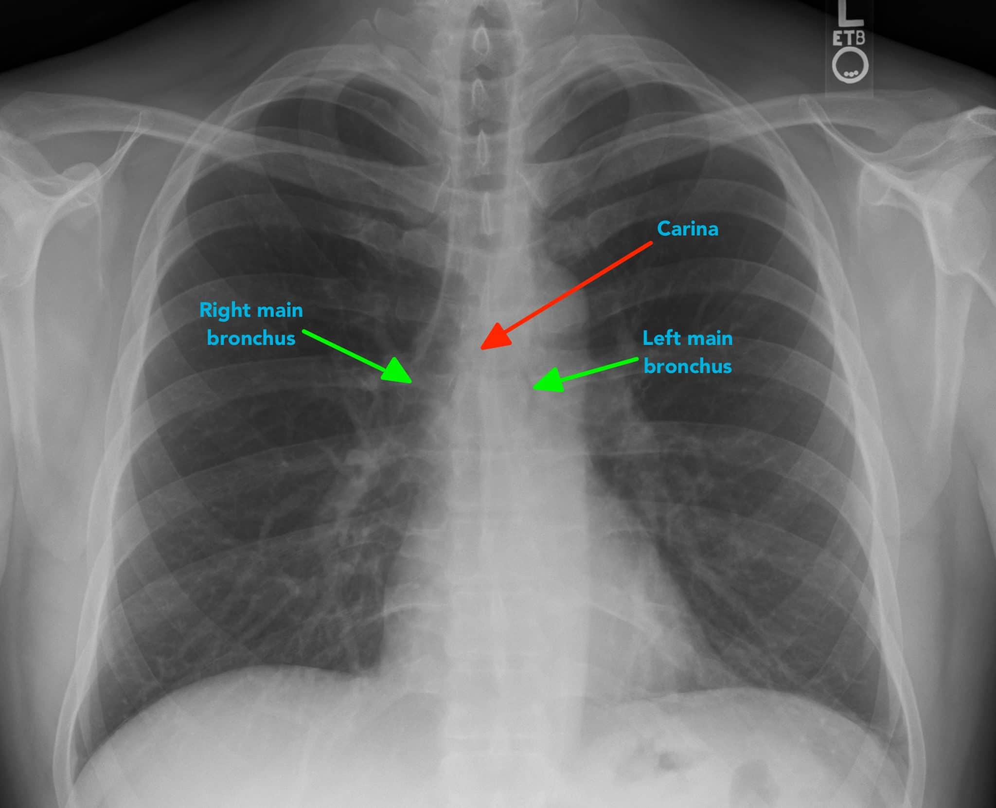 Chest Xray Interpretation A Structured Approach Radiology OSCE