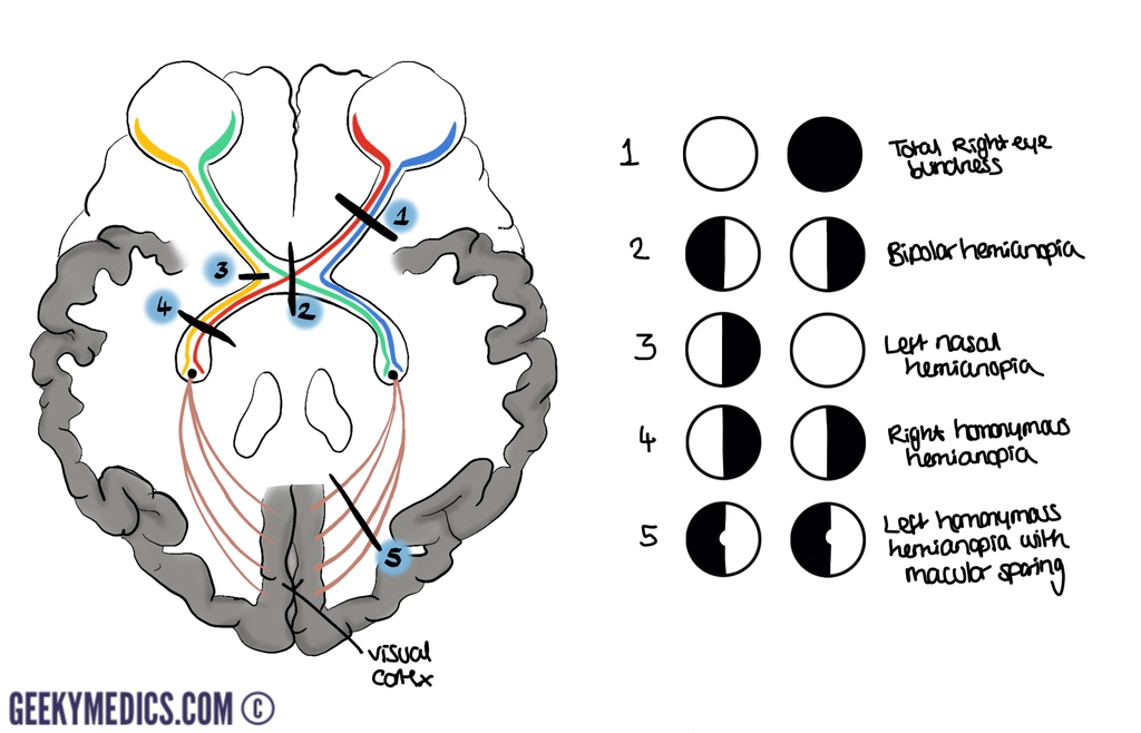 Eye Anatomy Blood supply Orbit Extraocular muscles Geeky Medics