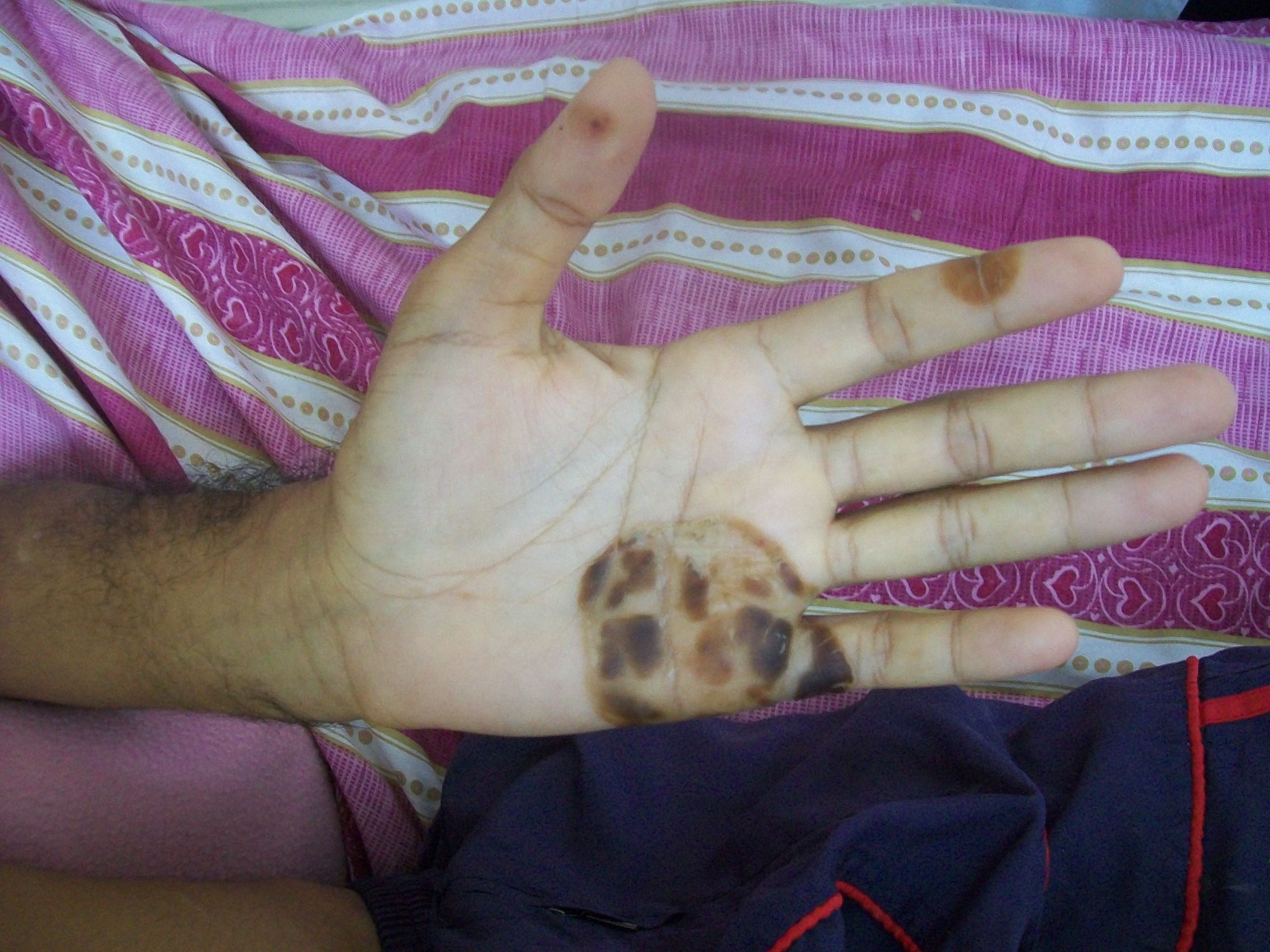 Clinical Signs of the Hands Geeky Medics