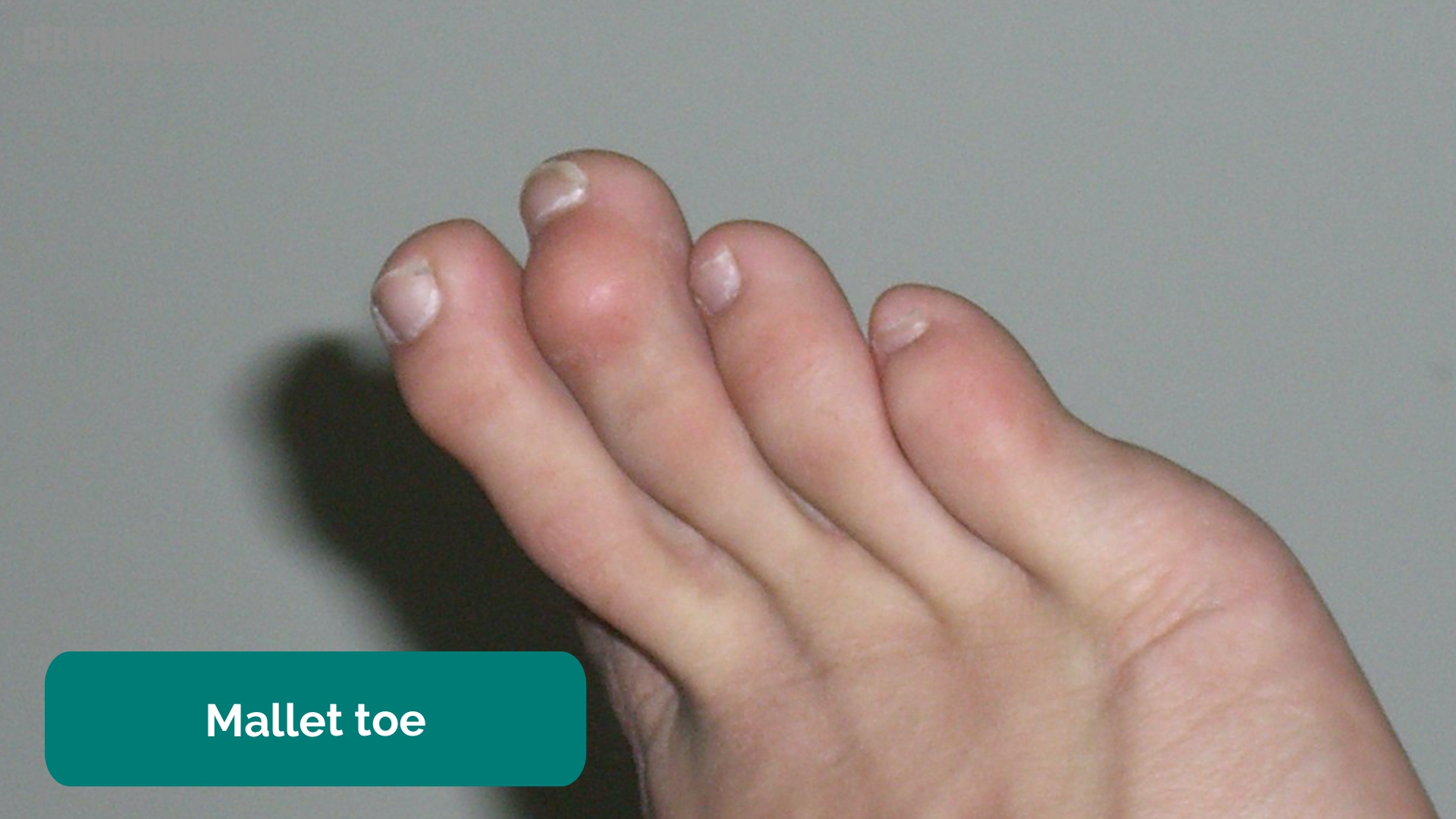 Ankle and Foot Examination OSCE Guide Geeky Medics
