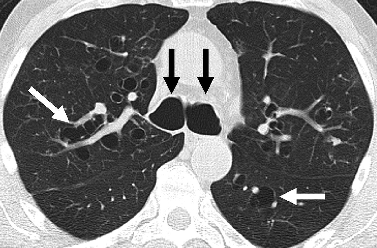 Bronchiectasis Symptoms, Signs, Management Geeky Medics