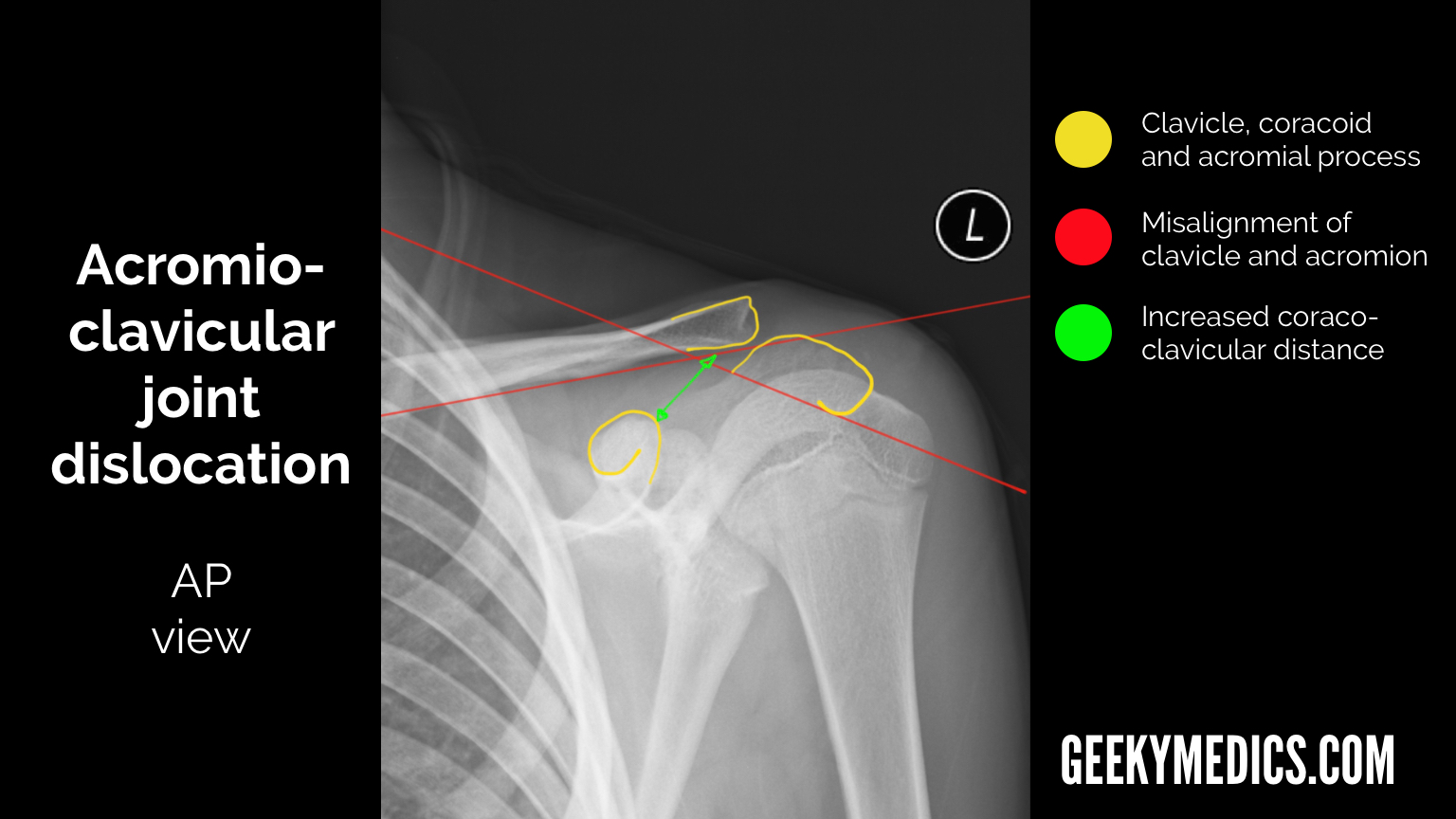 Shoulder Xray Interpretation Radiology Geeky Medics