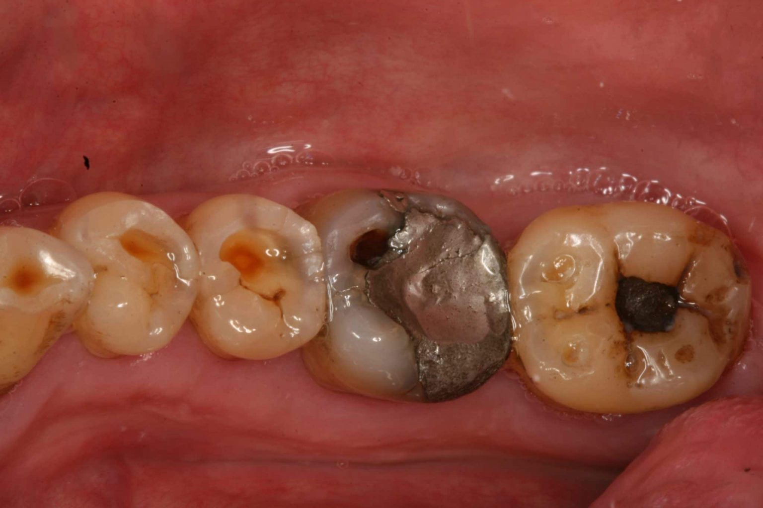Tooth Wear Diagnosis & Management Erosion Geeky Medics