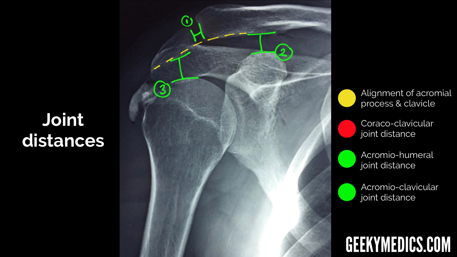 X Ray Normal Shoulder