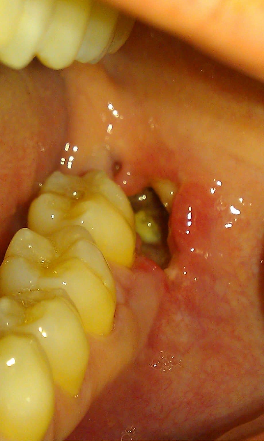 Complications of Dental Extractions Geeky Medics