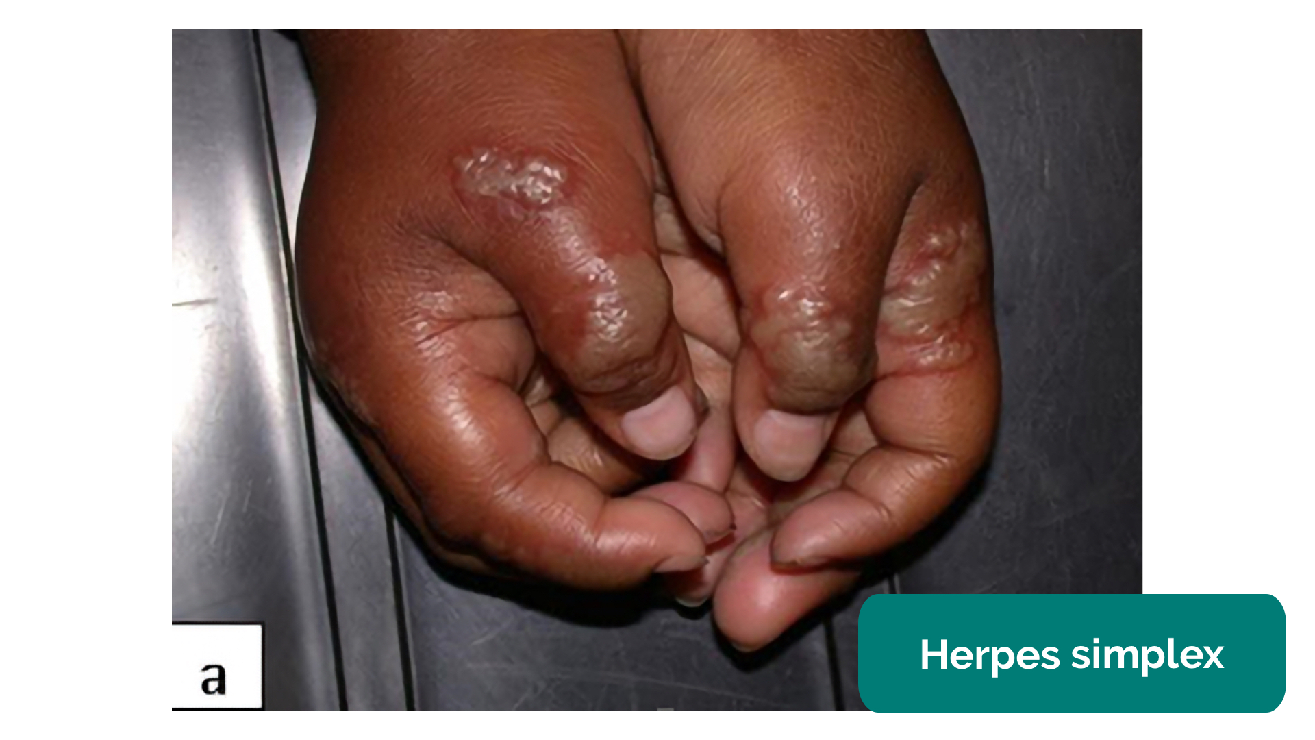 Examining a Skin Lesion OSCE Guide Geeky Medics