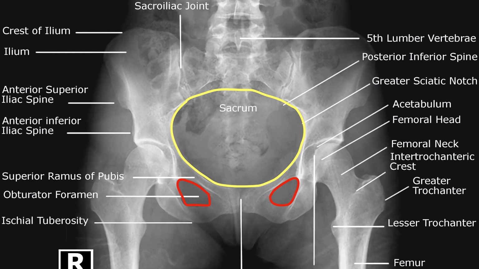 Hip Xray Interpretation OSCE Guide Geeky Medics