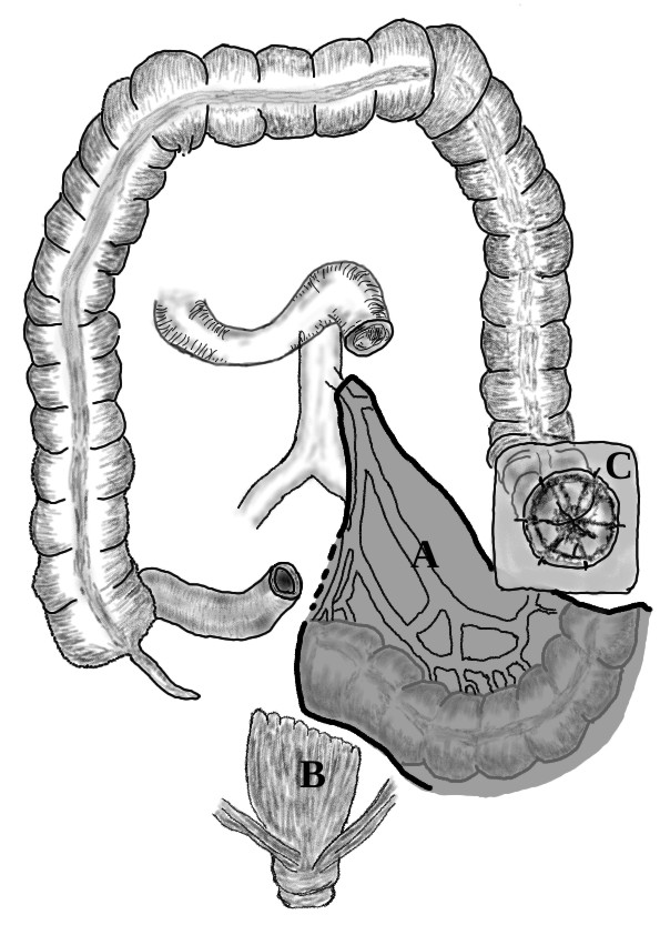 Diverticulitis | Diverticular Disease | Geeky Medics