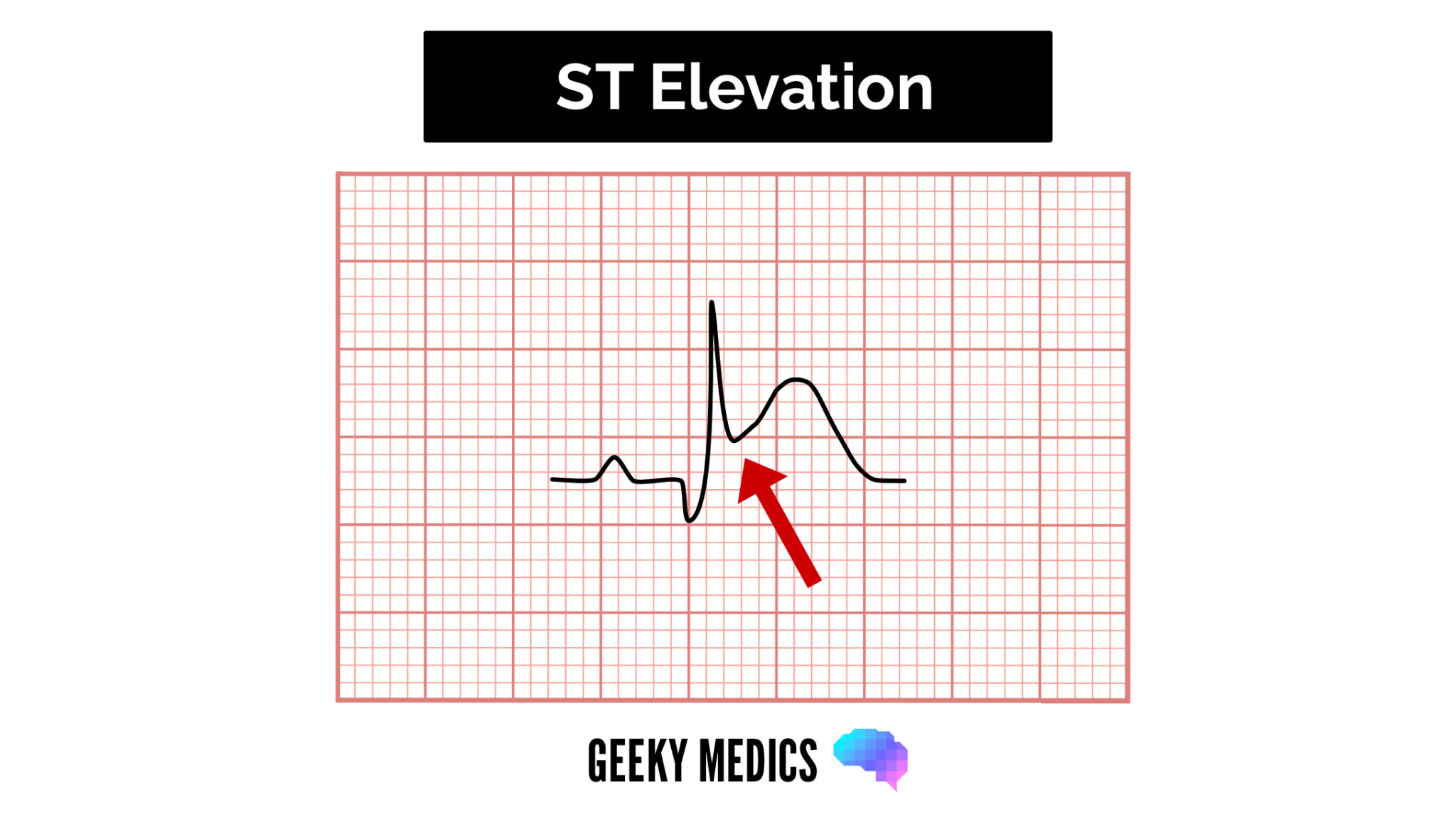 Acute Coronary Syndrome (ACS) Geeky Medics