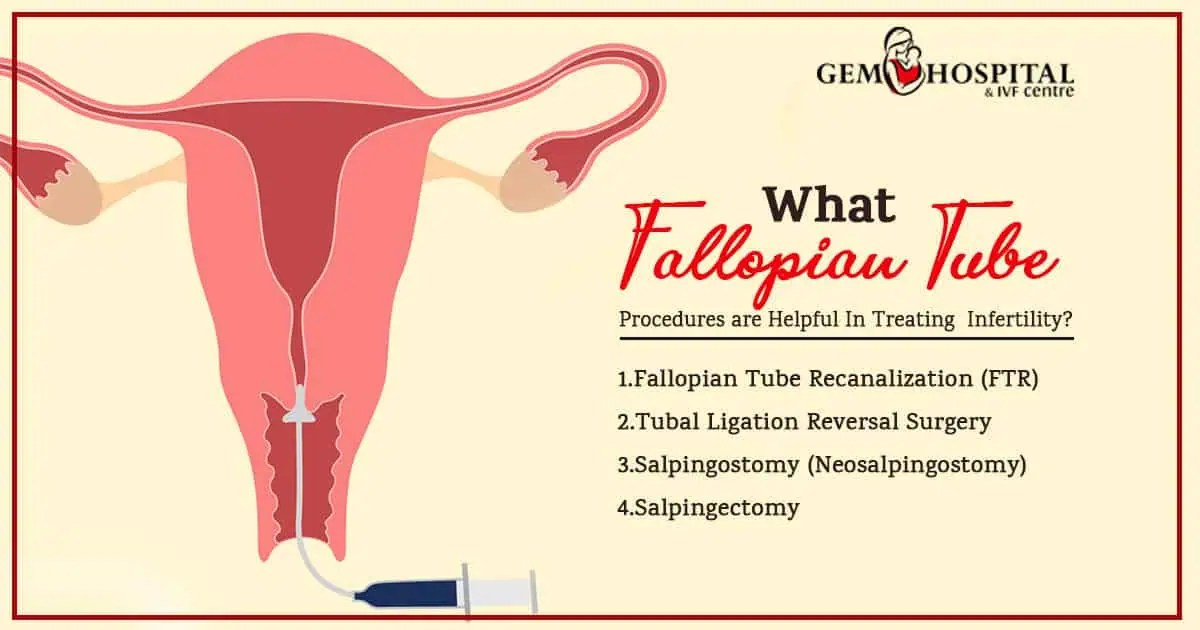 What Is Blocked Fallopian Tubes treatment Procedures for Infertility?