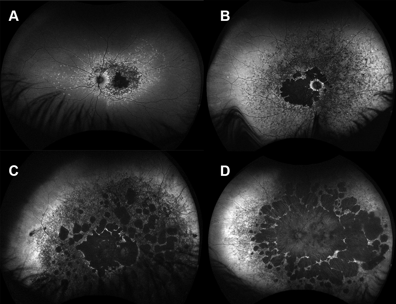 Cone/Conerod dystrophy for professionals Gene Vision
