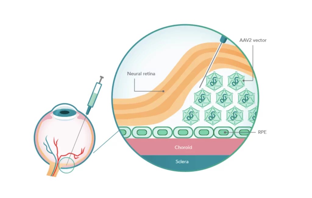 of Leber Congenital Amaurosis (LCA) & Gene Therapy