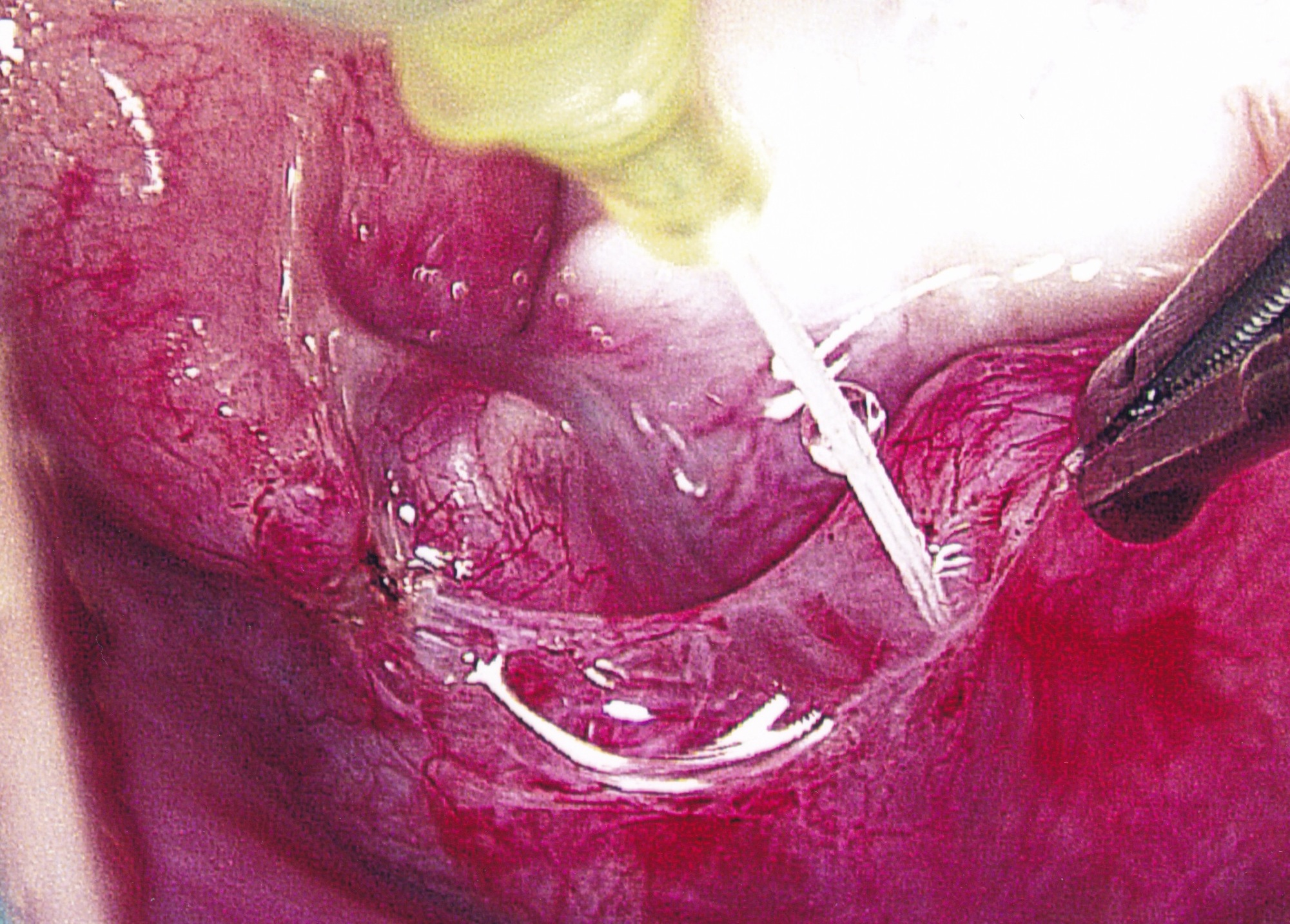 Tubal Reversal Method / Dr. Pabon / Tubal Reversals