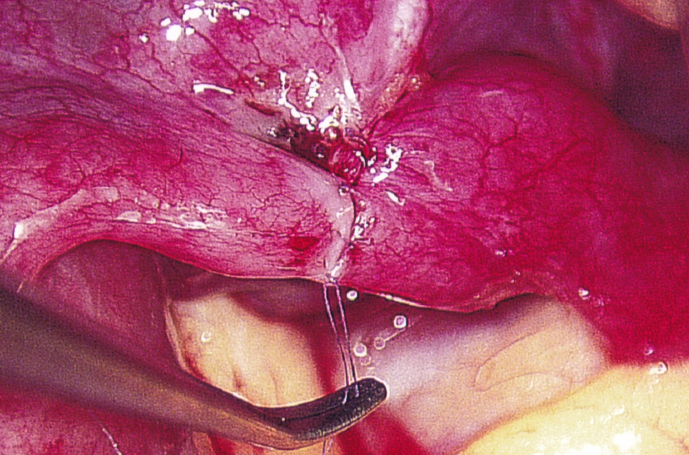 Tubal Reversal Method / Dr. Pabon / Tubal Reversals
