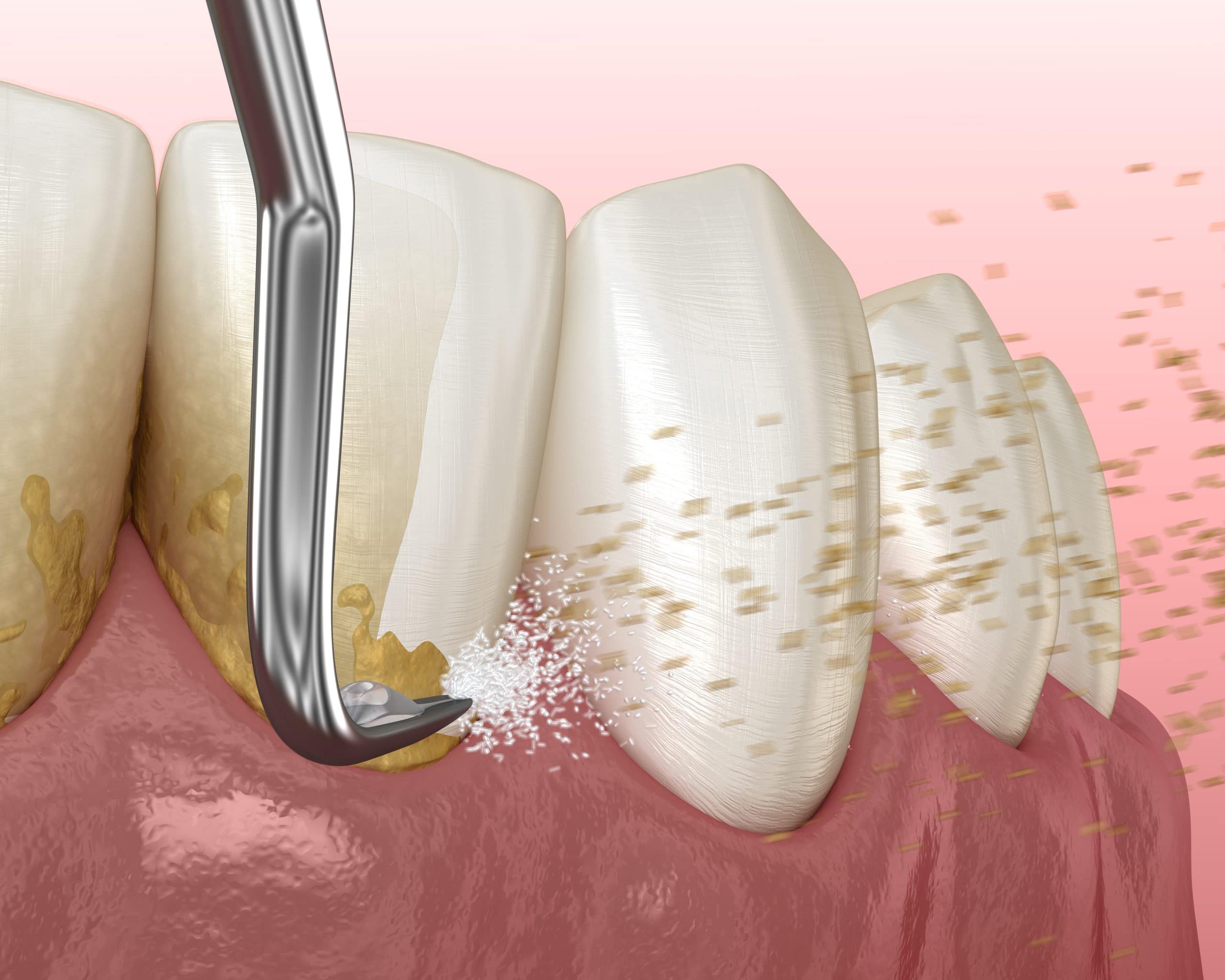 Oral hygiene Scaling and root planing (conventional periodontal