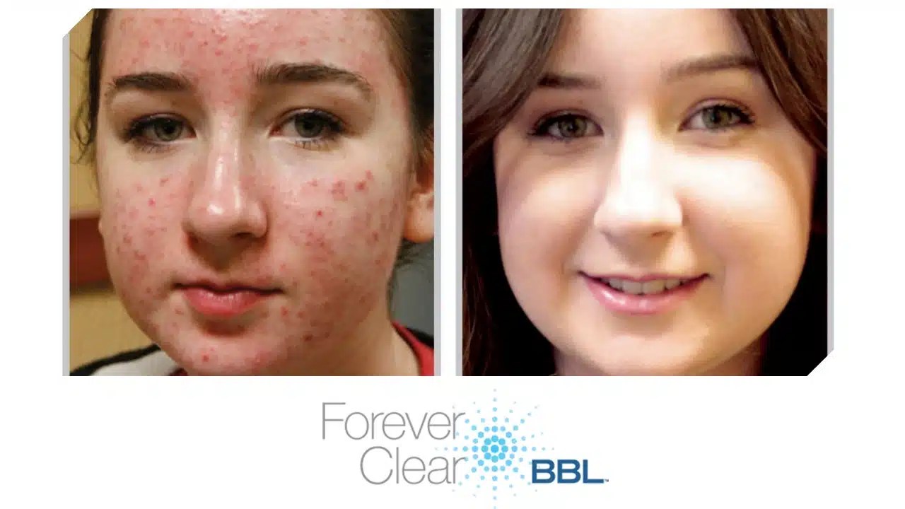 Acne Edmonds WA Delaney MD