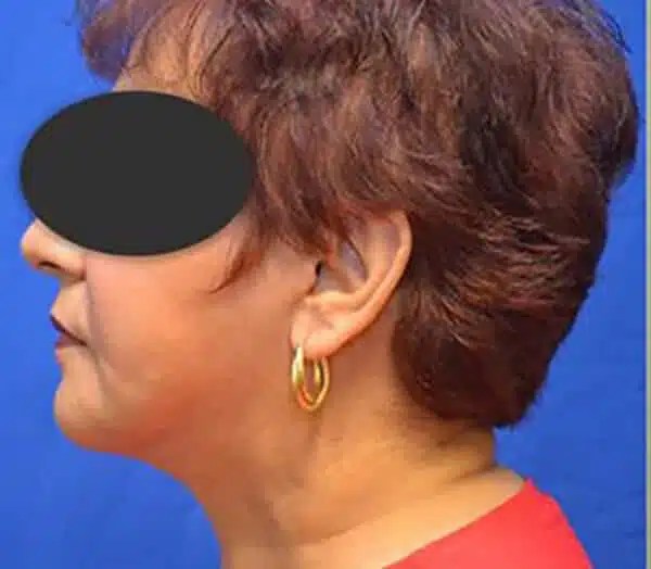 Facelift Gallery Plastic and Reconstructive Surgery