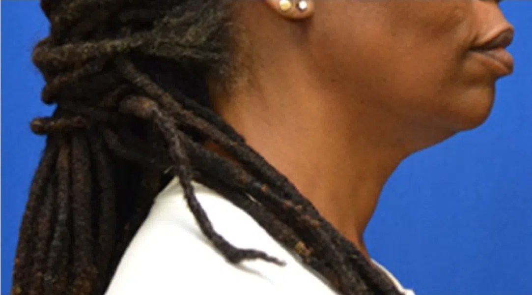 Facetite with Morpheus 8 Plastic and Reconstructive Surgery