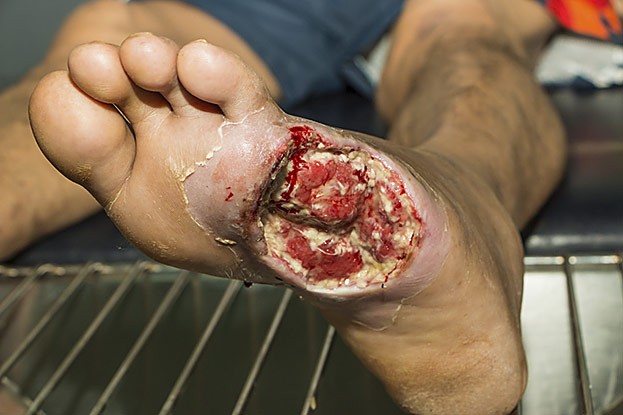 Diabetischer Fuß Versagen die Ärzte?
