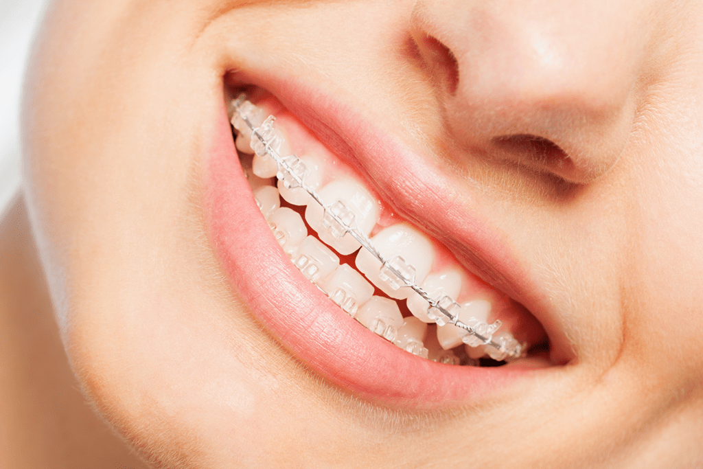 Dental Braces denTEL