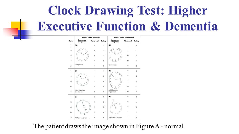 Dementia Clock Drawing at GetDrawings Free download