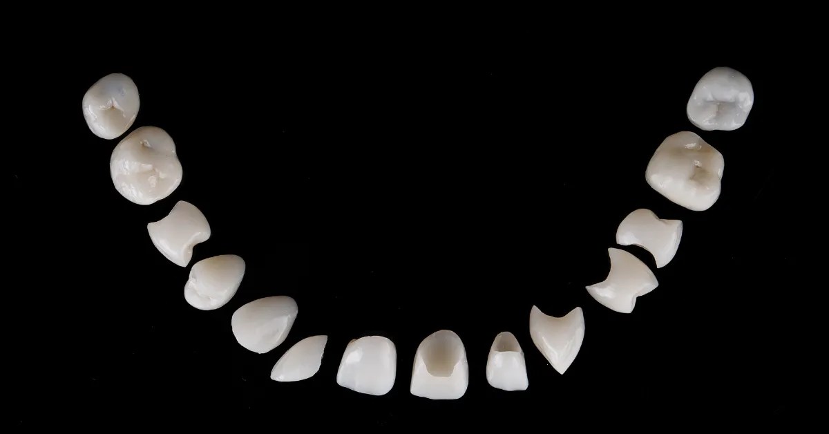 Veneers vs. Crowns What’s the difference?