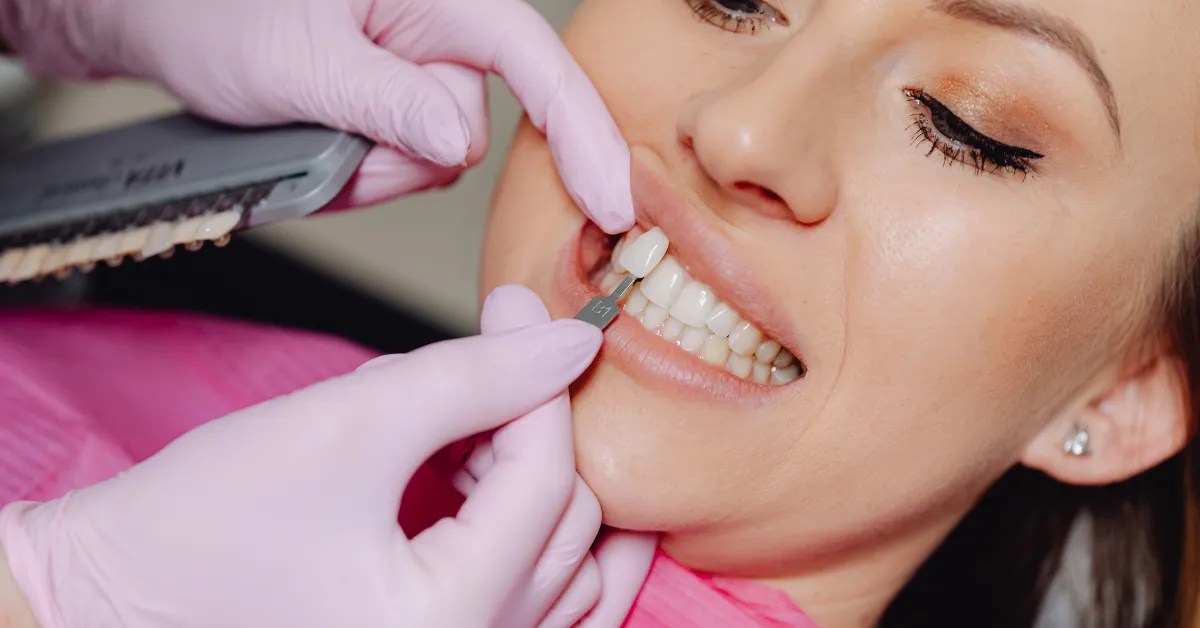 Are Veneers Permanent? Veneers Explained in 30 seconds