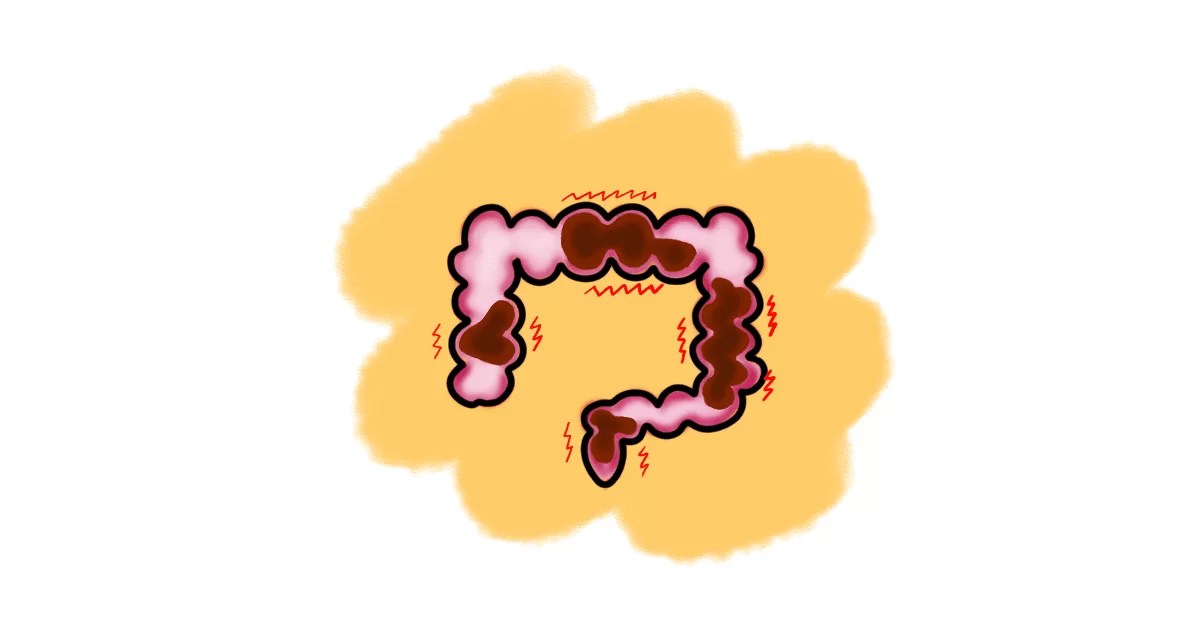 Functional constipation vs. slowtransit constipation