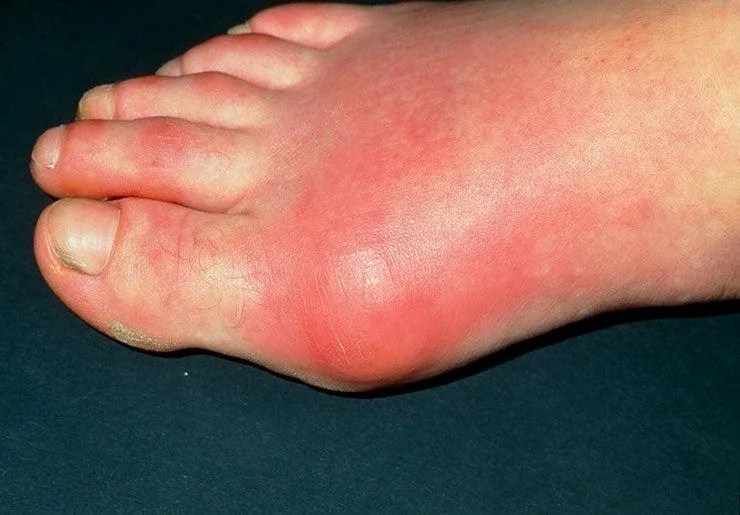 Bacon and Gout Understanding How Uric Acid Levels Can Trigger Gout Attacks