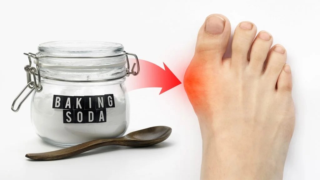 Baking Soda For Gout A Natural Remedy Worth Exploring