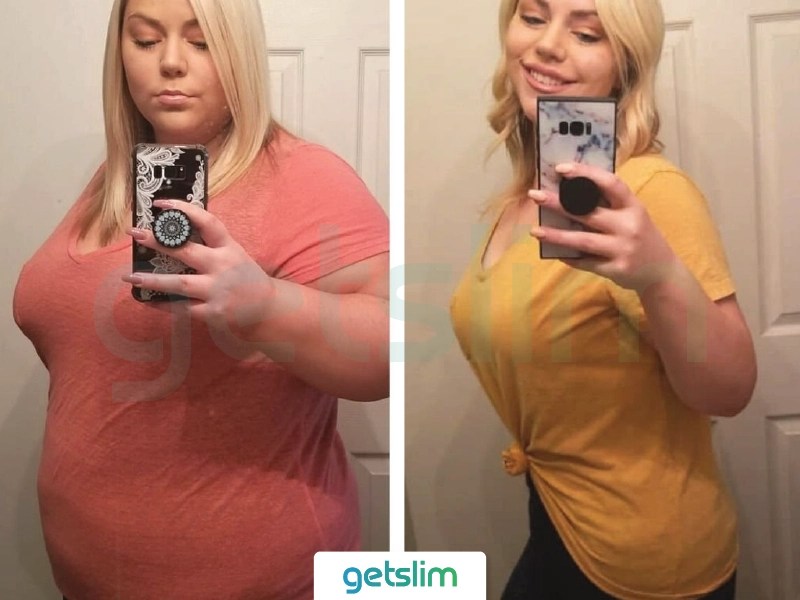 Weight Loss Surgery Turkey Before After Pictures Photos