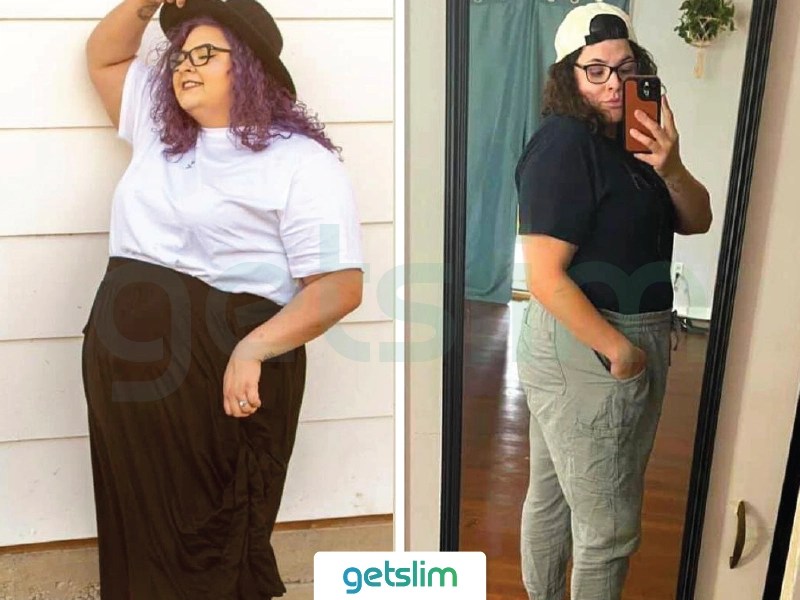 Weight Loss Surgery Turkey Before After Pictures Photos