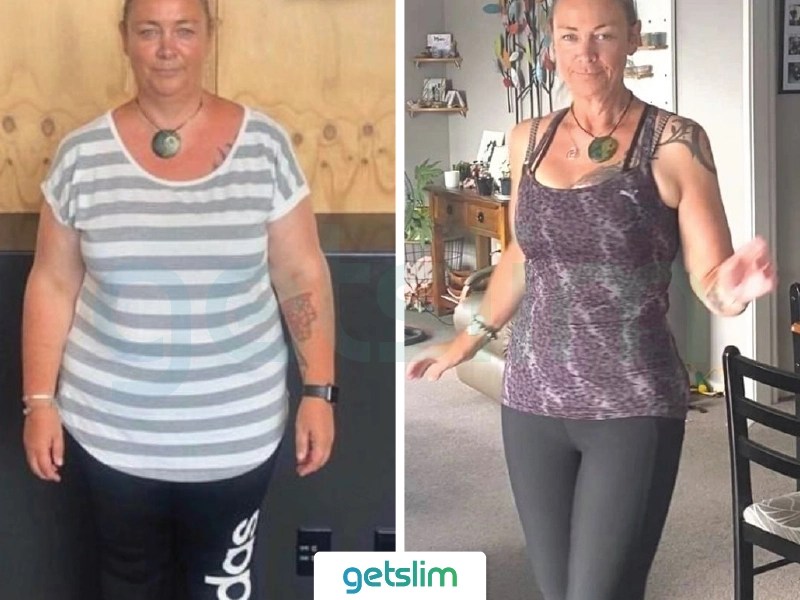 Weight Loss Surgery Turkey Before After Pictures Photos