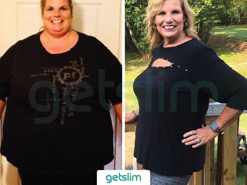 Weight Loss Surgery Turkey Before After Pictures Photos