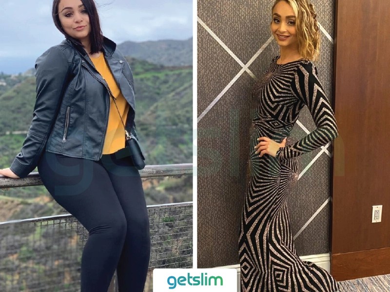 Weight Loss Surgery Turkey Before After Pictures Photos