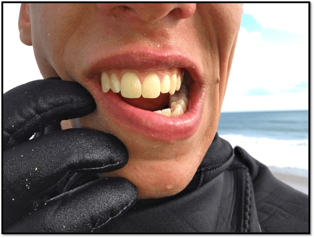 Antibiotics For Toothache Not Working Root Canal Toothache