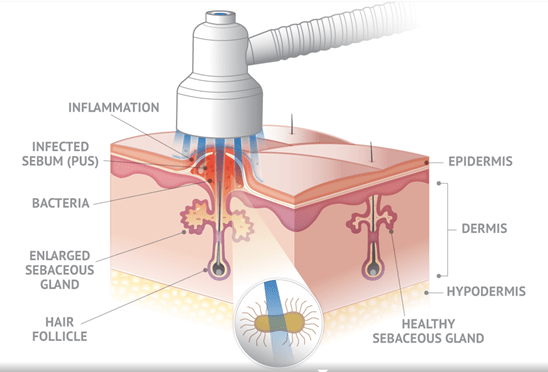Best At Home Blue Light Therapy for Acne Reviews & Guide (2019)