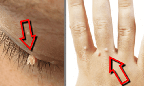 Natuurlijke Middelen Om Wratten Te Verwijderen - Gezonder Leven