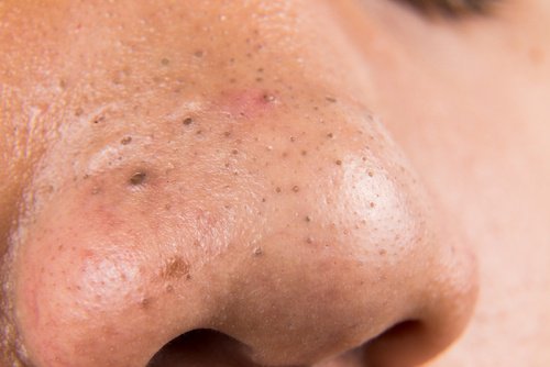 5 Huismiddelen Tegen Mee-Eters - Gezonder Leven