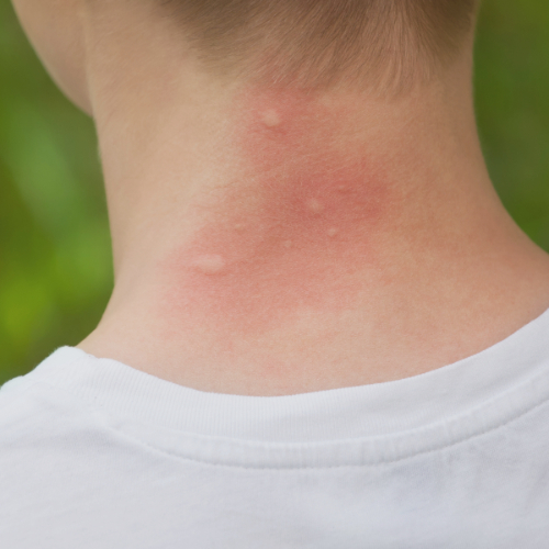 Allergische Reactie Muggenbeet: De Oorzaken En Symptomen