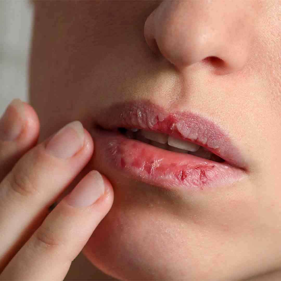 Get Rid of Chapped Lips Home Remedies