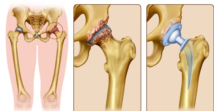 Total Hip Replacement Indications, Diagnosis, THR procedure explained