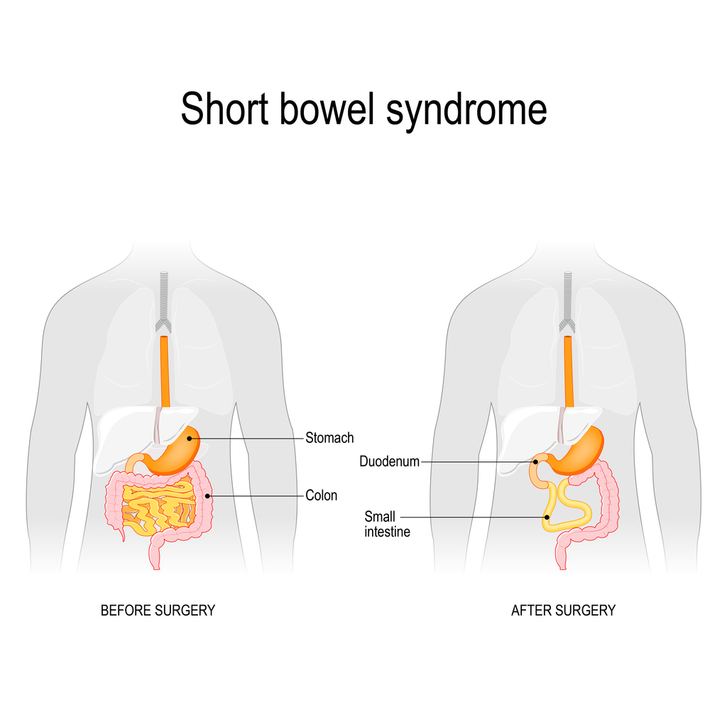 What is Short Bowel Syndrome Everything You Need To Know GI Associates