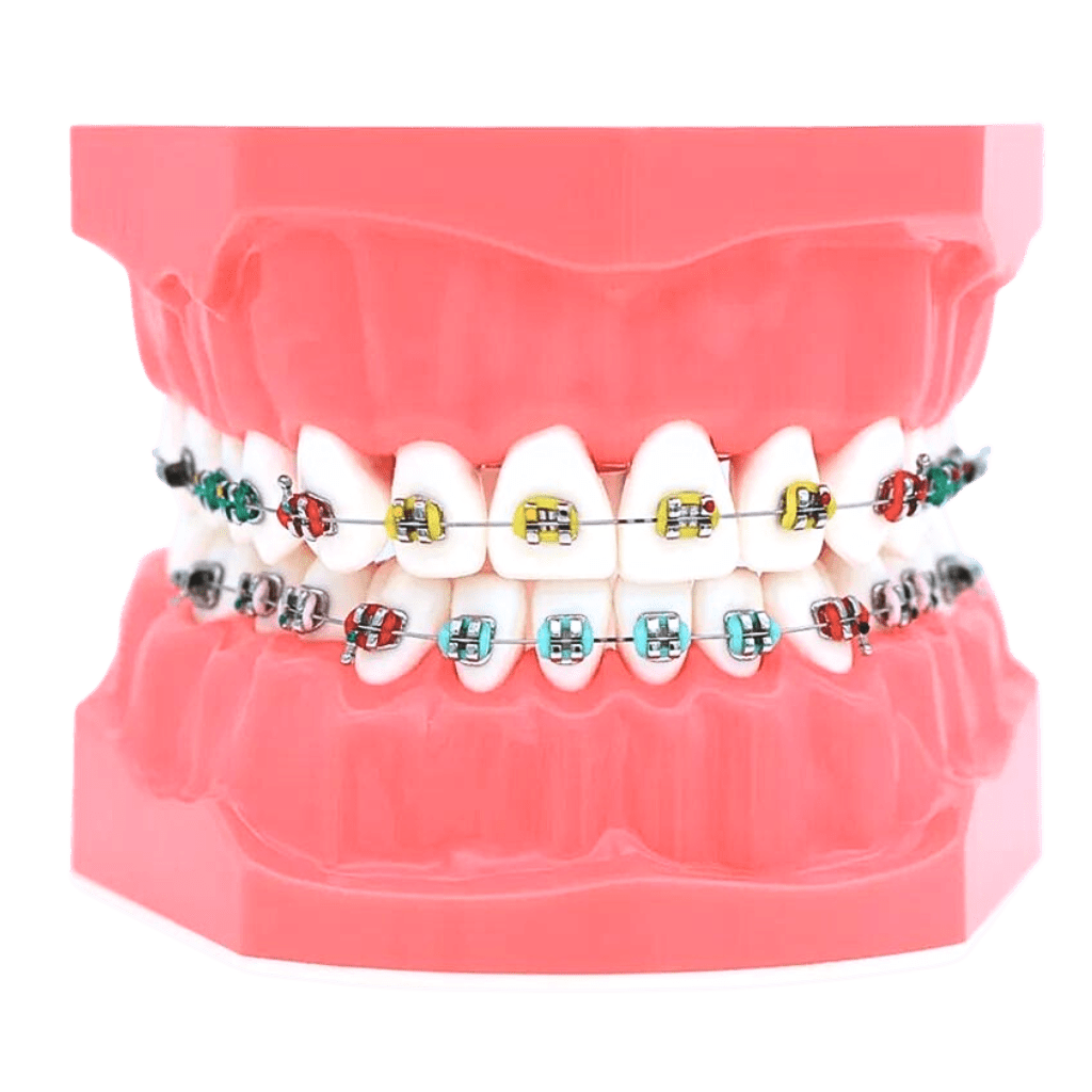 Braces Types and How They Work for Teeth Straightening GigiChun