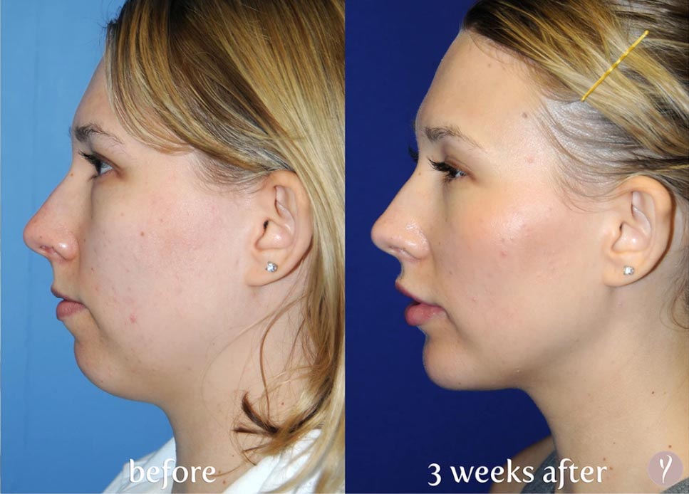 The Y LIFT in Gilbert Med Spa Gilbert Med Spa Serving Mesa