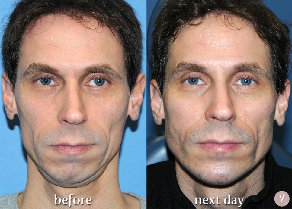 The Y LIFT in Gilbert Med Spa Gilbert Med Spa Serving Mesa