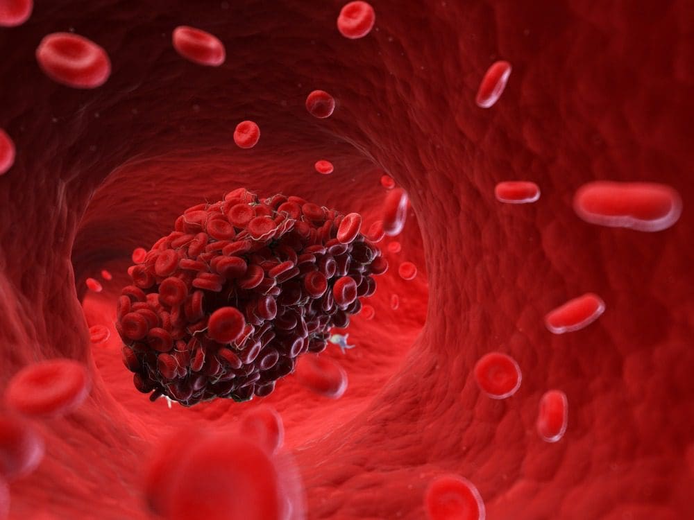 What Does a Blood Clot Feel Like? Gilvydis Vein Clinic