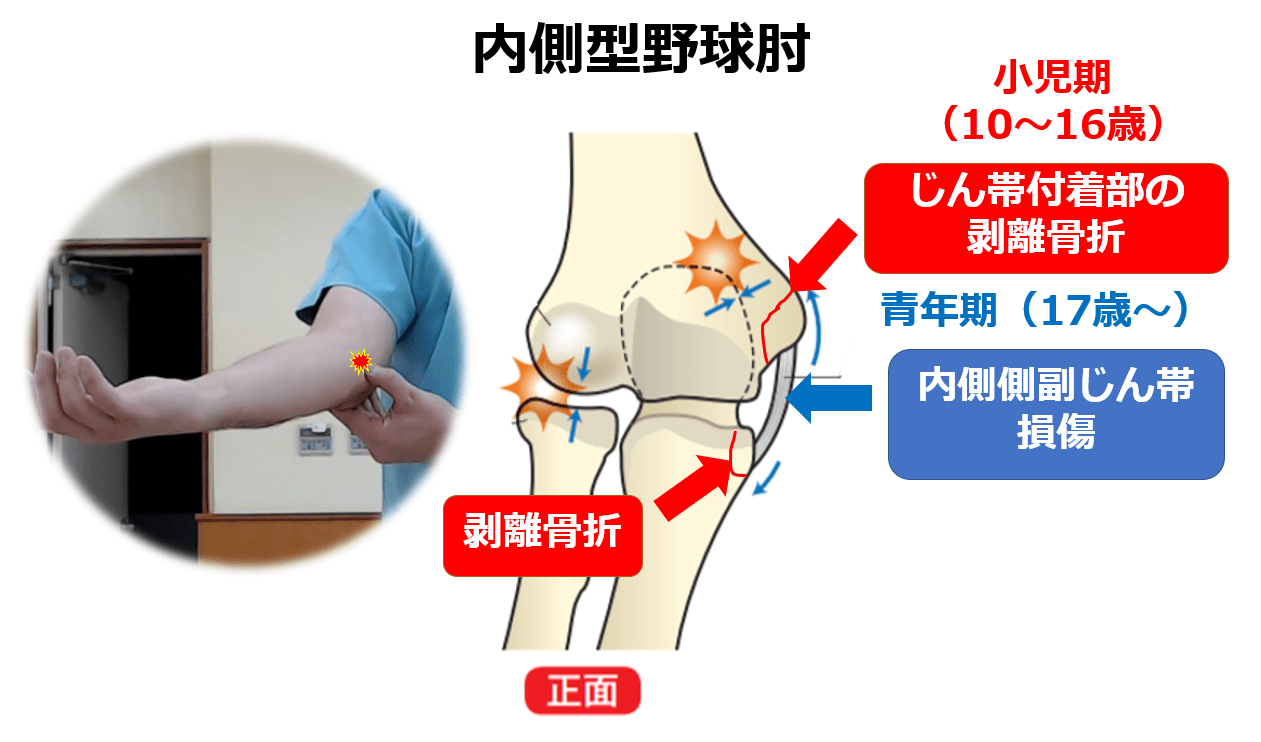 【野球肘の予防】外反ストレスに負けない肘を作るトレーニング