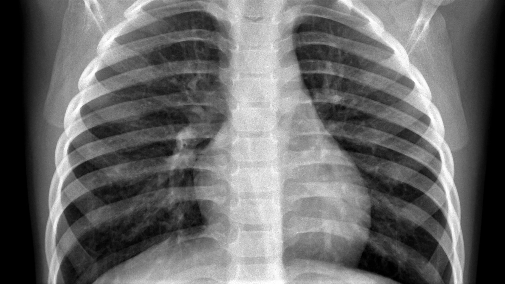 GitHub shredb/PneumoniadetectionusingchestXrayimagesand