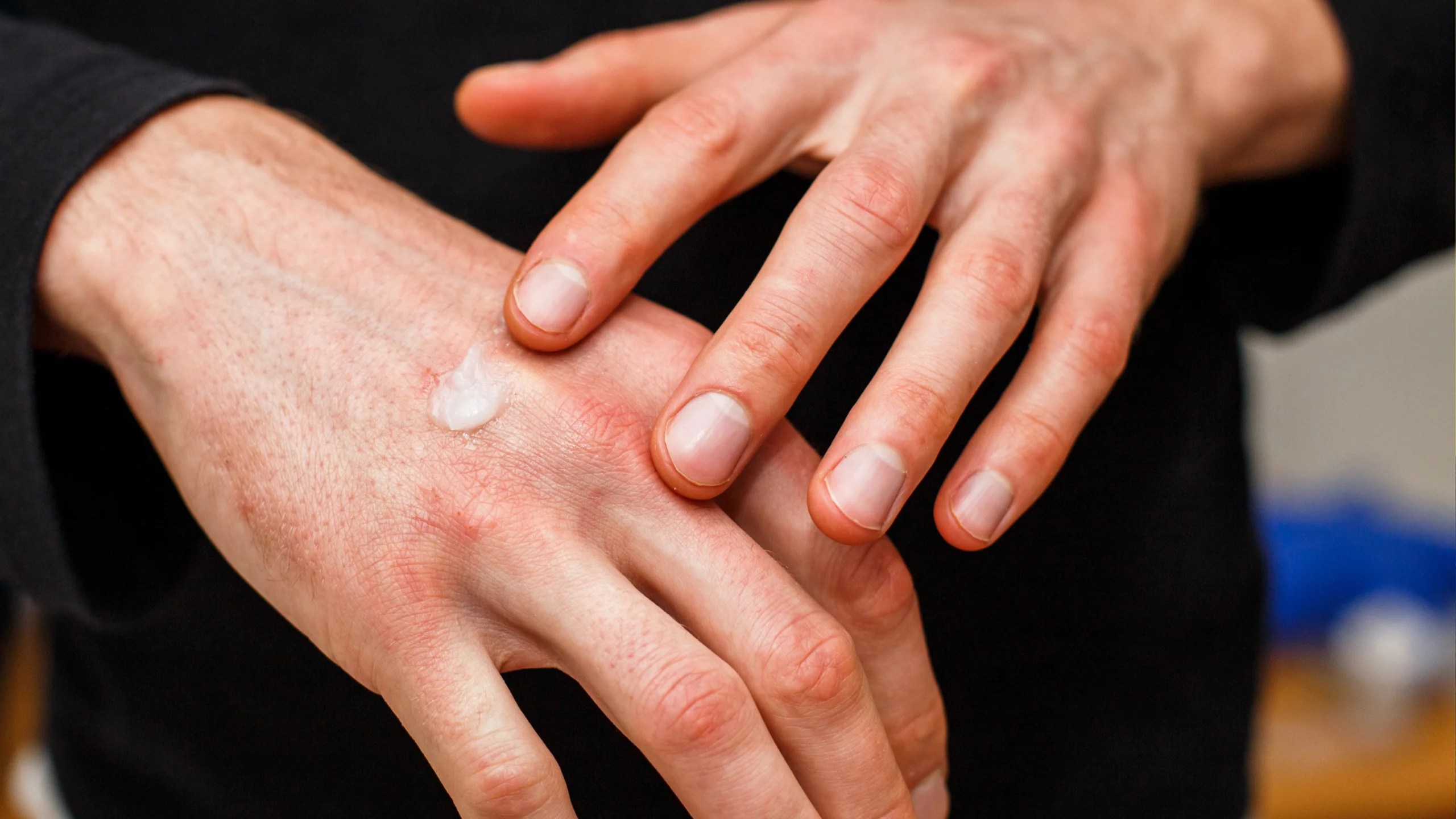 Topical Steroids Types, Side Effects, and How to Use Gladskin